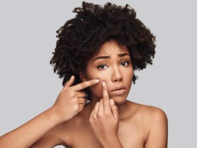 Crème CBD contre l’acné : guide complet