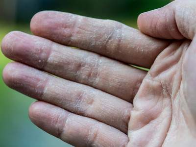 Pourquoi le CBD peut-il traiter l’eczéma et le psoriasis ?